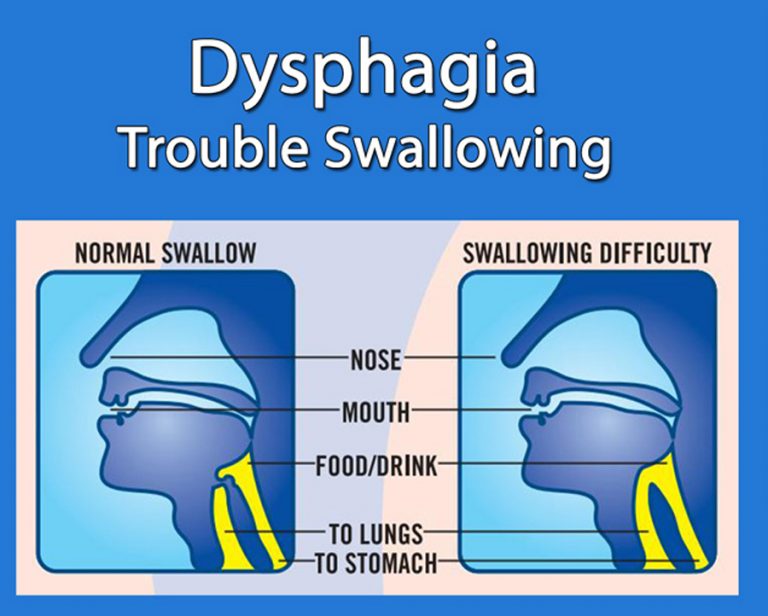 swallowing-difficulties-diagnostics-and-treatments-in-south-louisiana